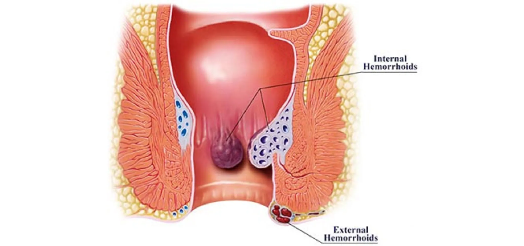 Ayurvedic Solution for Piles - Dosage & Benefits